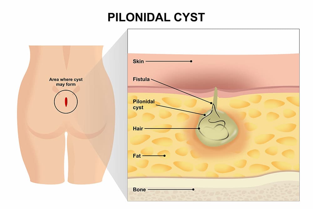An illustration of a pilonidal cyst